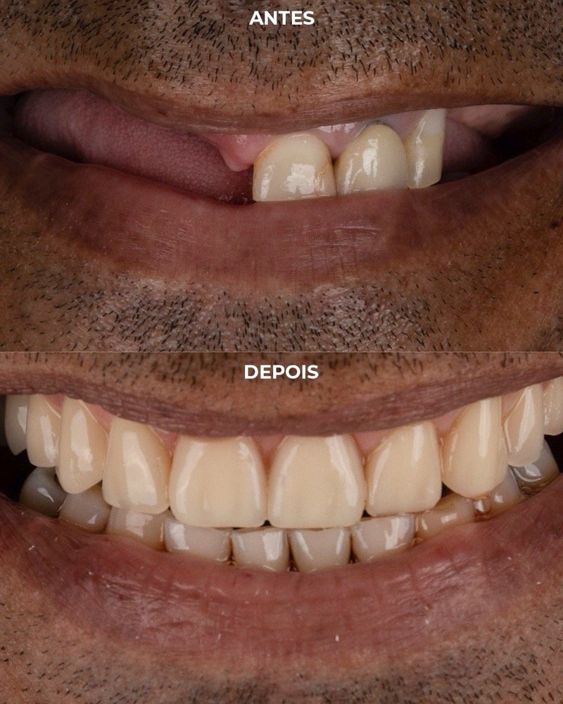 Caso real de antes e depois de implante dentário